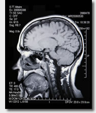 MRI of brain